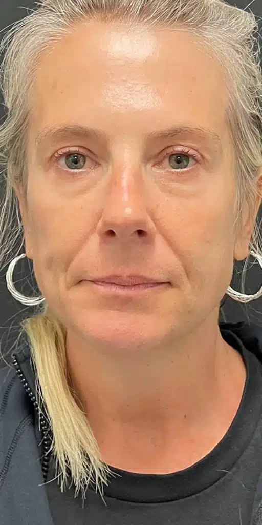 case 1 botox b1