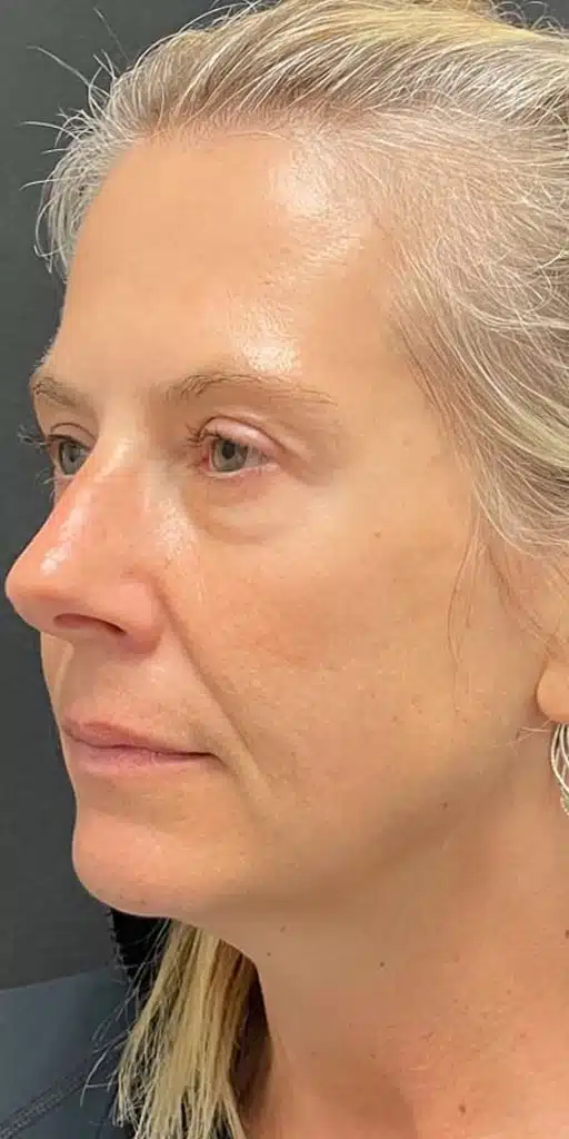 case 1 botox b2