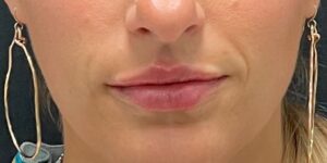 After Image: Lip Filler