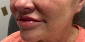 After Image: Lip Filler