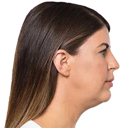 case 9 kybella2 b1